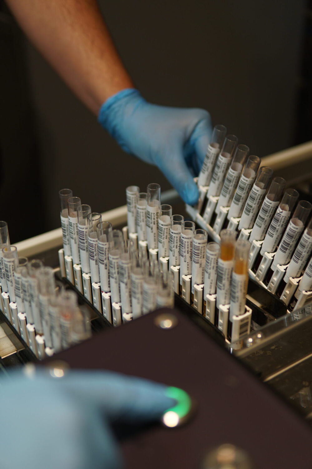 (ACP Testi) Asit fosfataz nedir? Asit fosfataz yüksekliği, düşüklüğü